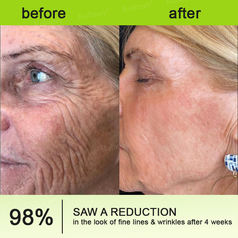 C🇺🇸Made and shipped from the USA ⌛Rolimey® Botox & Vita-A Retinol Shot Wrinkle-Lift Tightening cream - Last Day Promotion 70% OFF