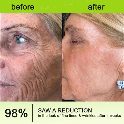 C🇺🇸Made and shipped from the USA ⌛Rolimey® Botox & Vita-A Retinol Shot Wrinkle-Lift Tightening cream - Last Day Promotion 70% OFF