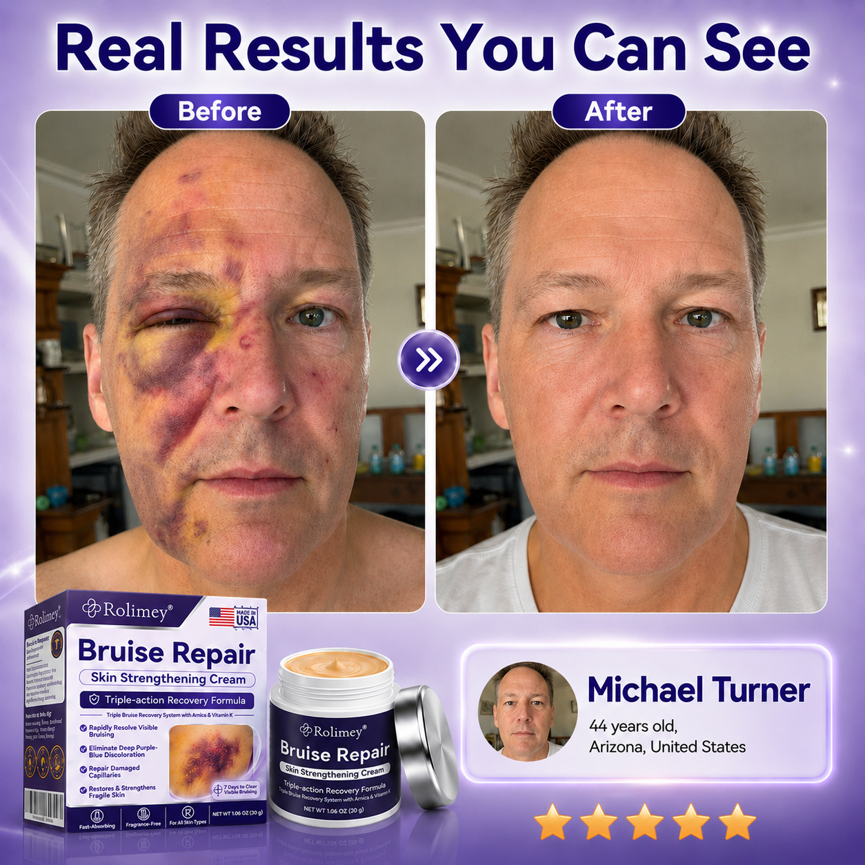 🔥Over 100,000 units sold👨‍⚕️ - Rolimey® cream to repair bruises and strengthen the skin.