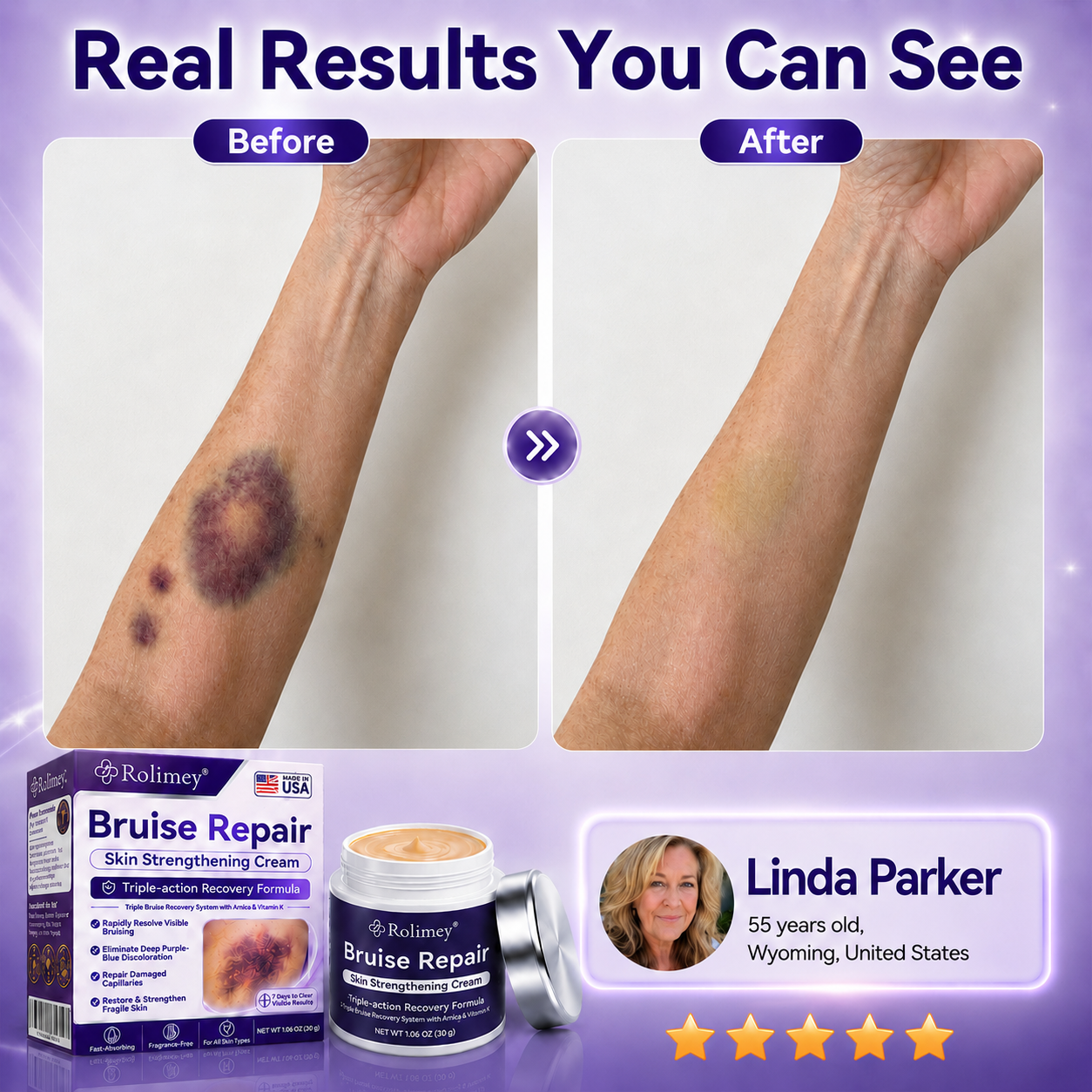 🔥Over 100,000 units sold👨‍⚕️ - Rolimey® cream to repair bruises and strengthen the skin.