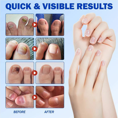 🌙 FUNGEX Overnight Nail Repair Patches - Thick & Yellow Nail Care