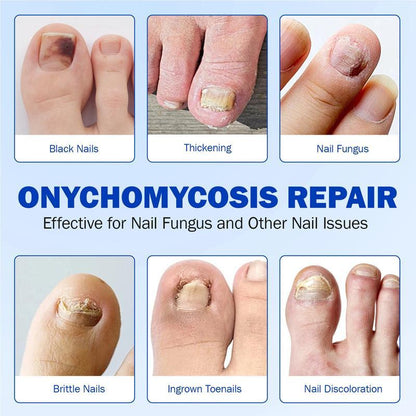 🌙 FUNGEX Overnight Nail Repair Patches - Thick & Yellow Nail Care